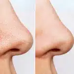 روغن پاک کننده و کنترل منافذ 200 میل آنوا - Image 2