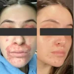 سرم تسکین دهنده آزلائیک اسید مدی کیوب 30 میل Medicube Azelaic Acid 16 BB Calming Serum - Image 2